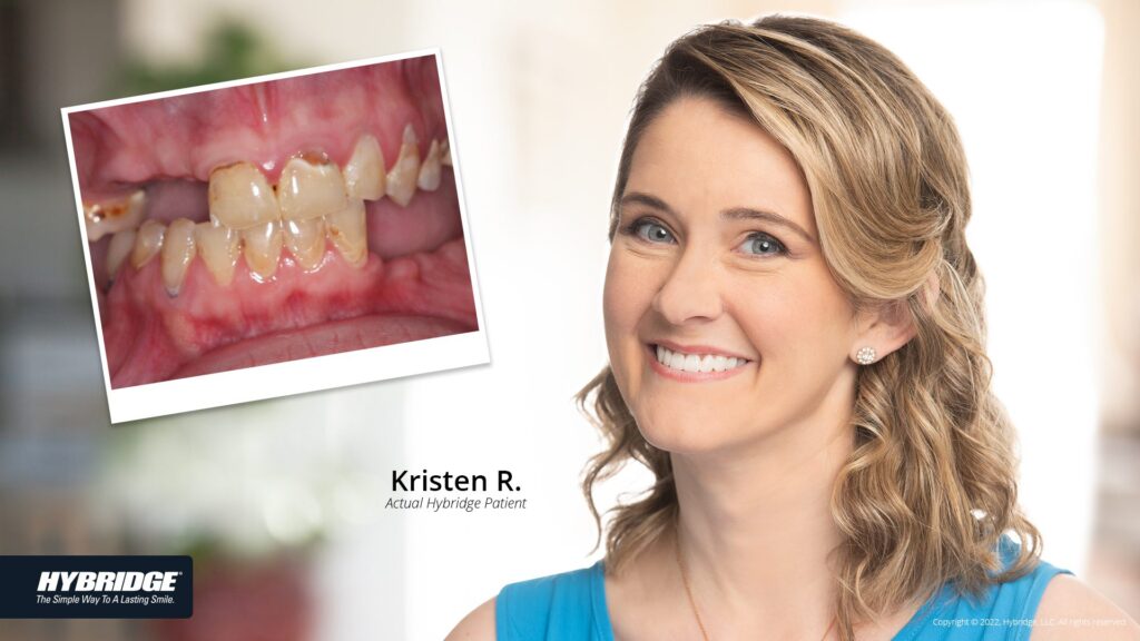 before-after_smile_gallery_w-bkgds_kristen-r_1920x1080.jpg